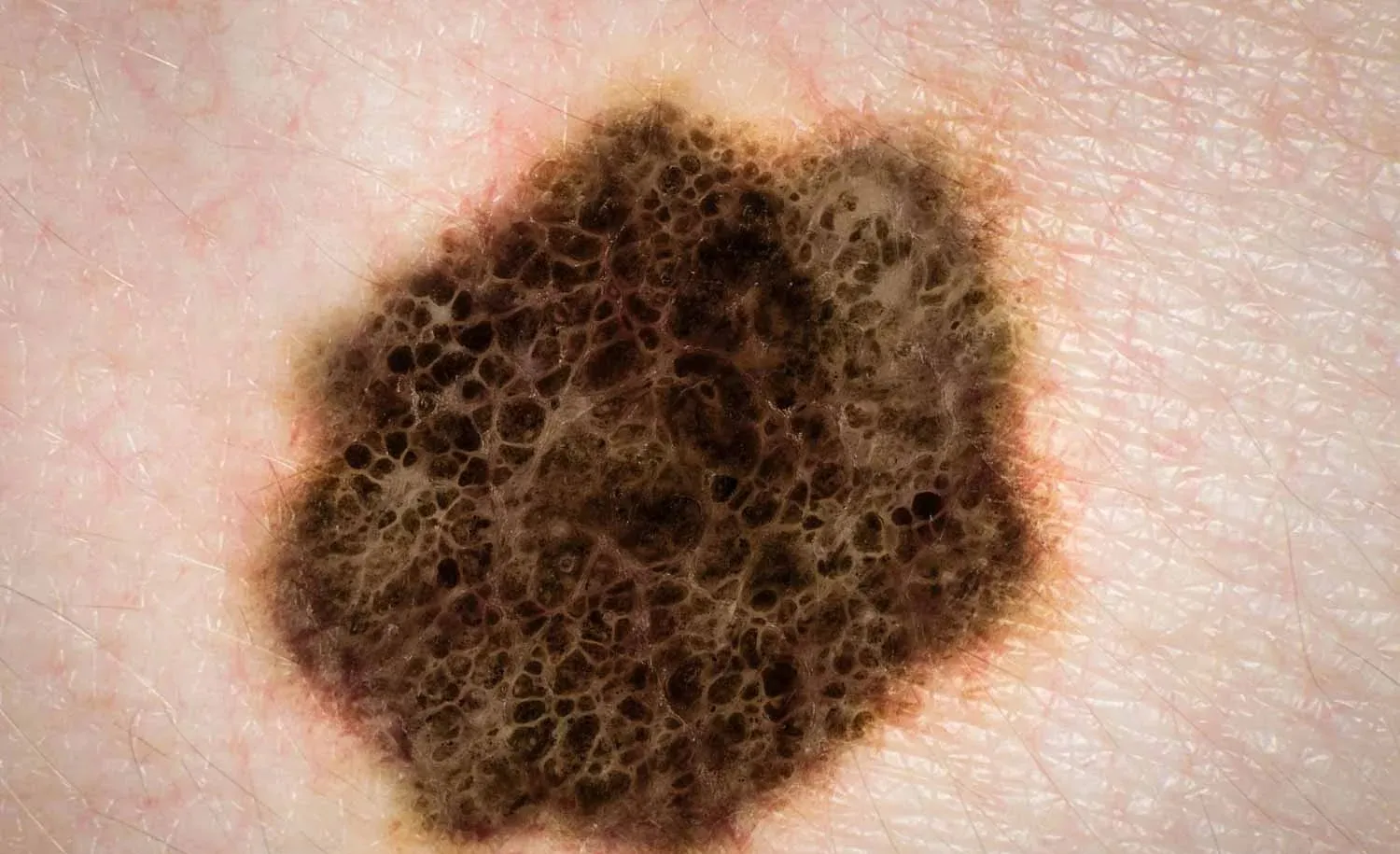 Acercamiento de un melanoma: lesión pigmentada de bordes irregulares y distintos tonos de café sobre la piel