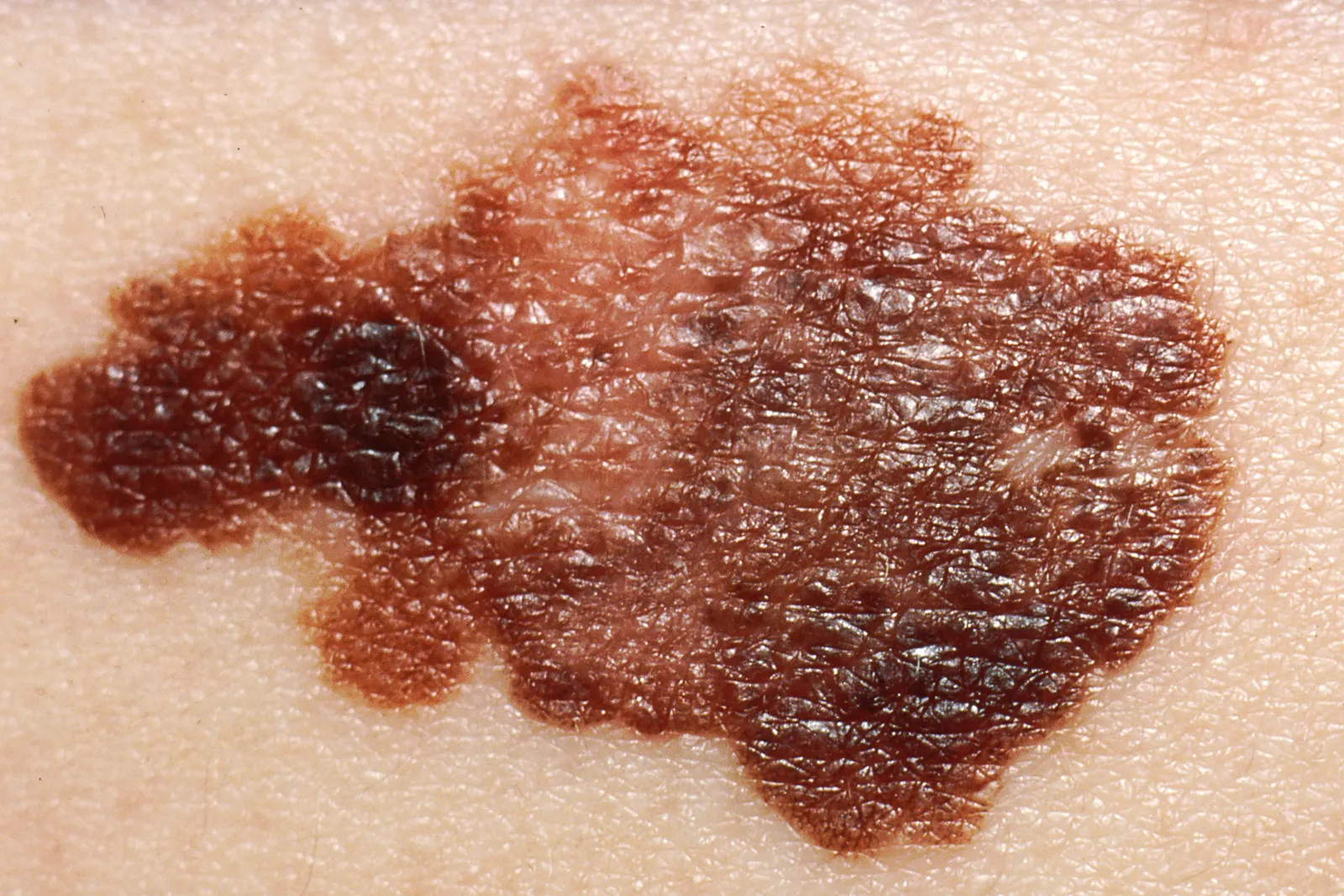 Primer plano de un melanoma: lesión pigmentada asimétrica, de bordes irregulares y color no uniforme