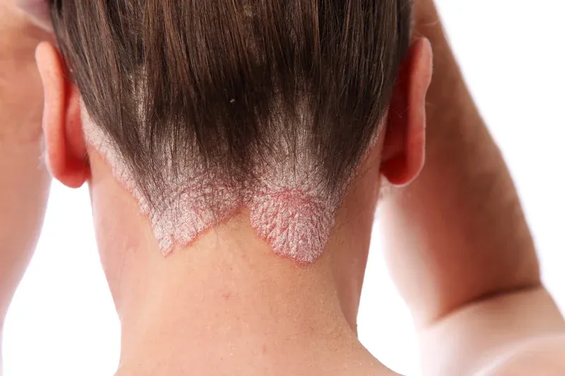 Fotografía de piel afectada por psoriasis