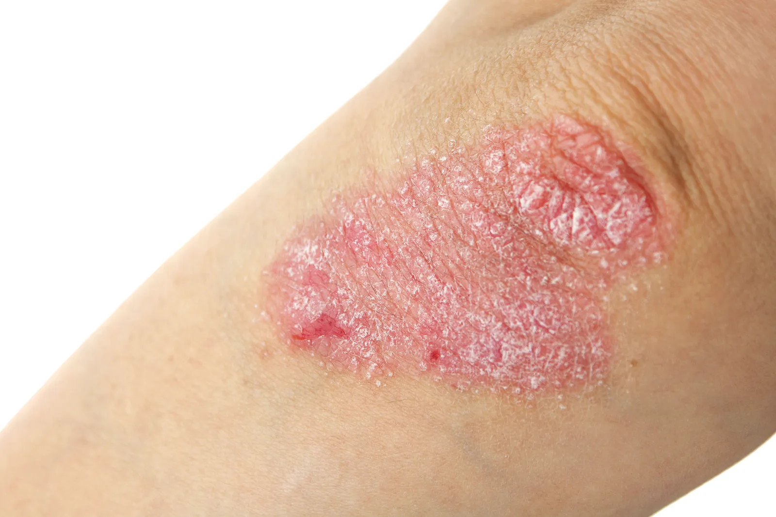 Placa de psoriasis con descamación en la piel del brazo